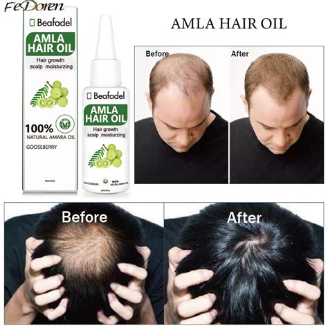 https://tse1.mm.bing.net/th?q=amla oil for hair loss